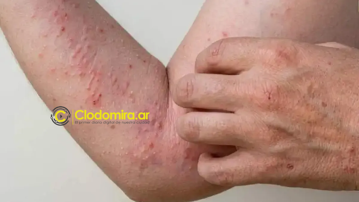 chikungunya-jujuy-foto-ilustrativa