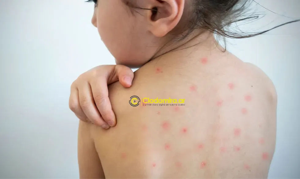 measles-su19